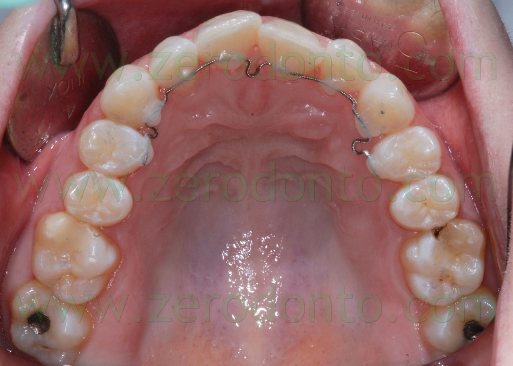 2-ortodonzia invisibile