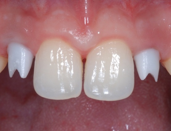 2-trattamento_ortodontico-implantare