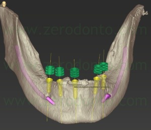 3-inserimento implantare