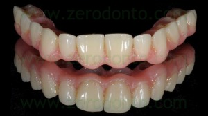3-nobel biocare full arch zirconia