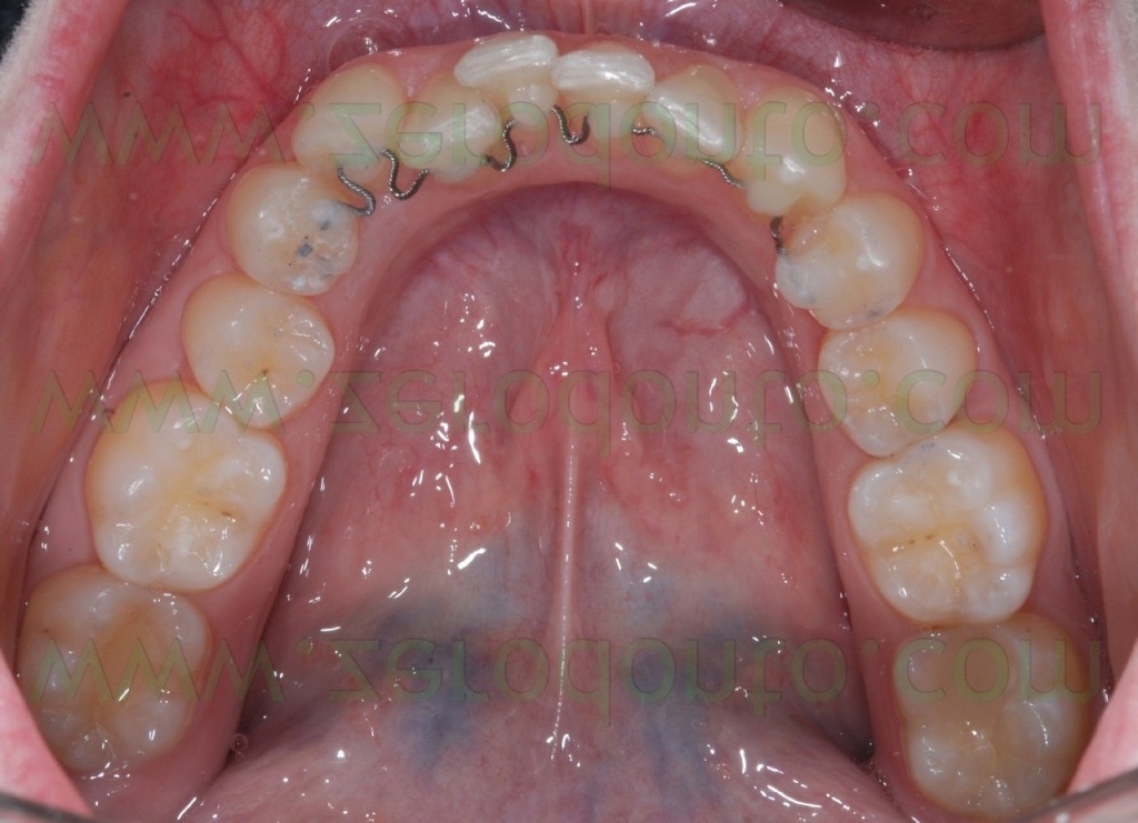 3-ortodonzia linguale