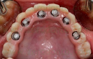 4-protesi zirconia ceramica integrale full arch