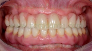 5-sorriso perfetto edentulia totale