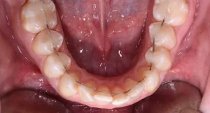 bracketless_fixed_orthodontics