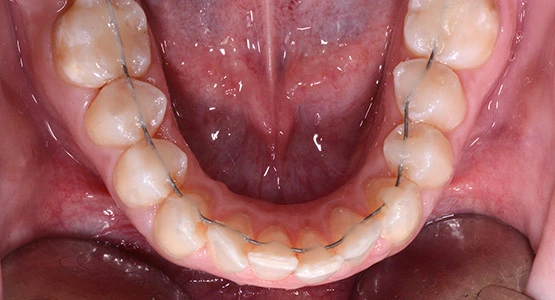 bracketless_fixed_orthodontics