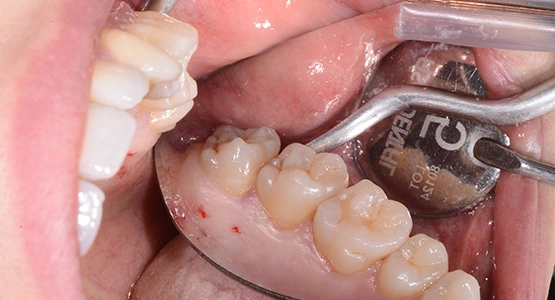 Wisdom Tooth Estraction