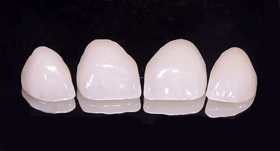 Dental veneers