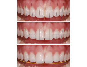 treatment planning for veneer coverage