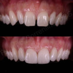 diastema