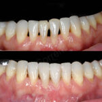 teeth with interdental spaces