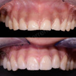 dental erosion 