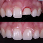 fractured tooth