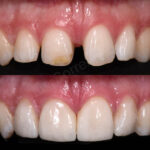 misaligned teeth