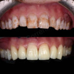 discolored teeth