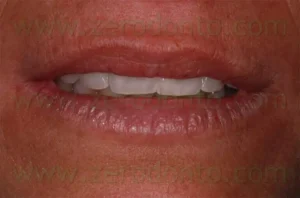 Gain 10 years with the veneers