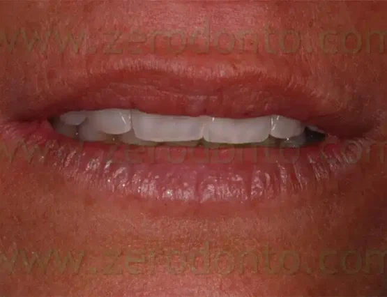 Gain 10 years with the veneers