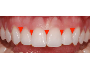 interdental embrasures: definition