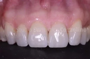 How does the no-prep veneer technique work?