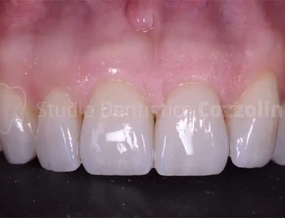 How does the no-prep veneer technique work?