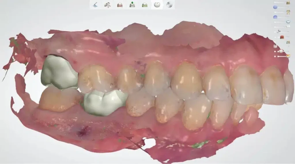 Digital Impression for Veneer Placement