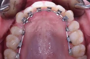 lingual braces