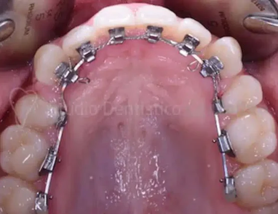 lingual braces