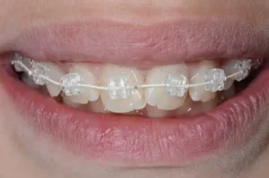 ceramic brackets