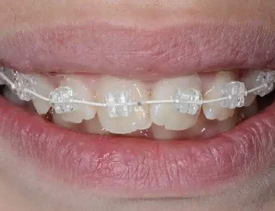 ceramic brackets
