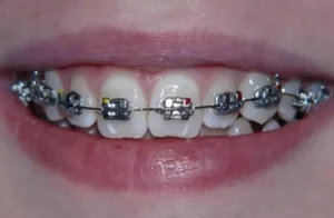 metal brackets
