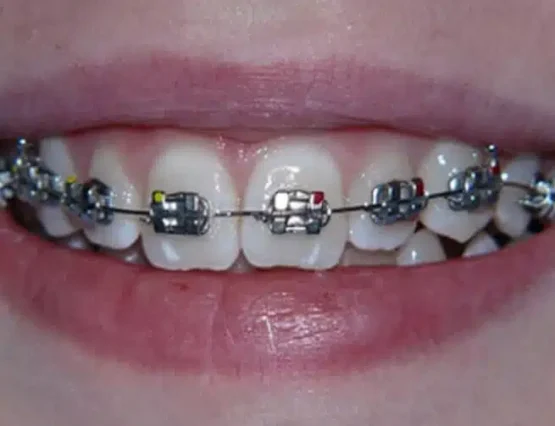 metal brackets