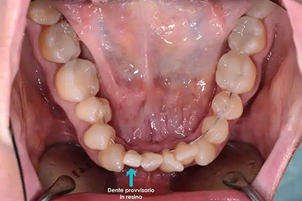 provisional resin tooth