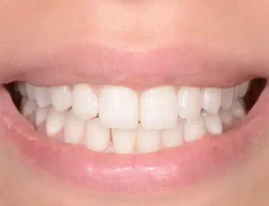 invisible orthodontics