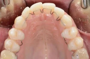 active retainer