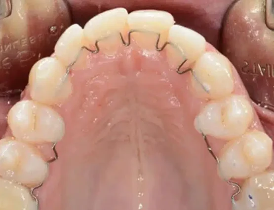 active retainer